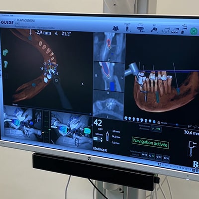 Guided implant surgery