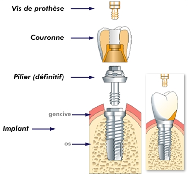 prothese vissee